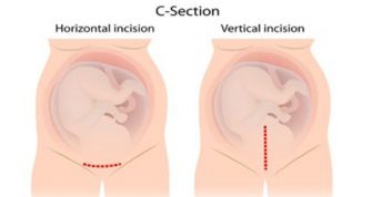 c section face presentation